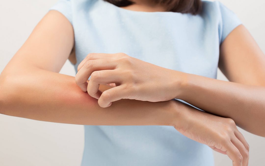 濕疹或皮膚敏感的成因以及解決方法